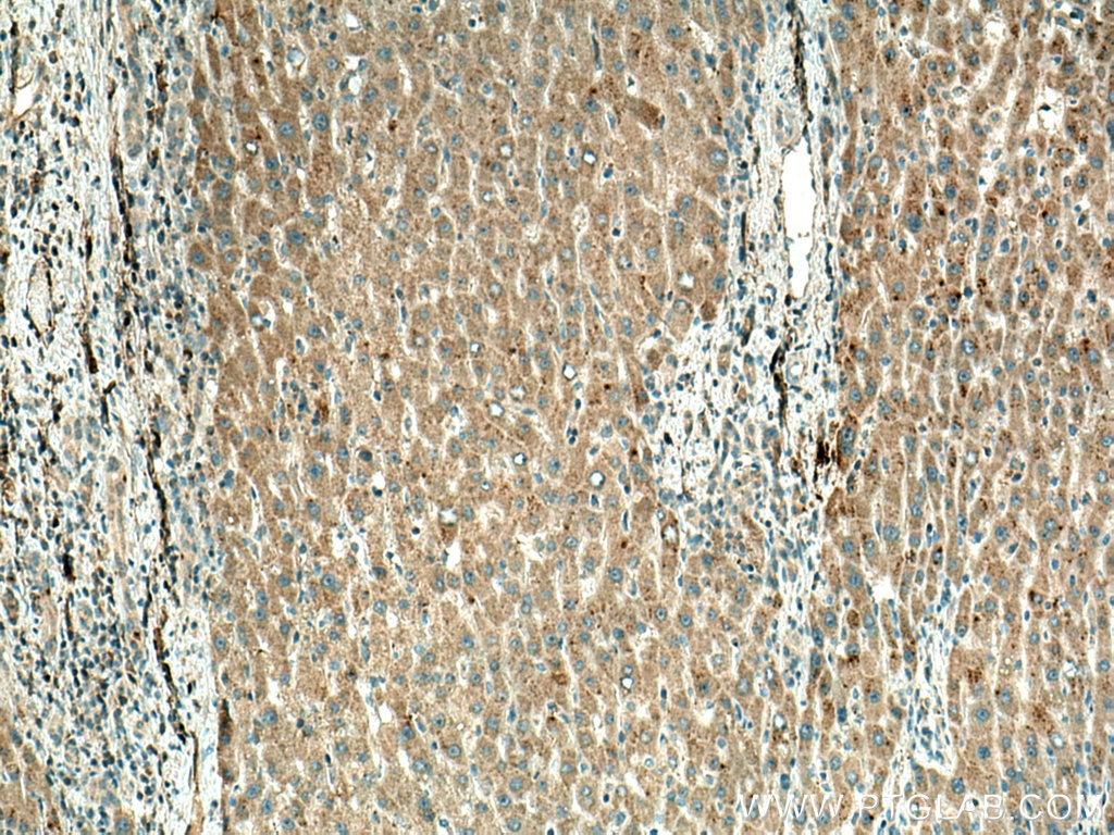 IHC staining of human liver cancer using 67392-1-Ig