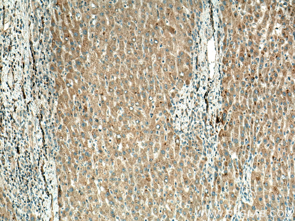 Immunohistochemistry (IHC) staining of human liver cancer tissue using PPP4R1 Monoclonal antibody (67392-1-Ig)