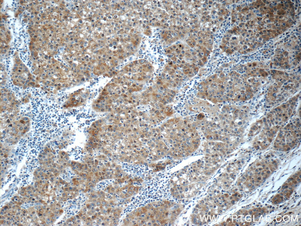 Immunohistochemistry (IHC) staining of human liver cancer tissue using PPP4R2 Polyclonal antibody (22676-1-AP)