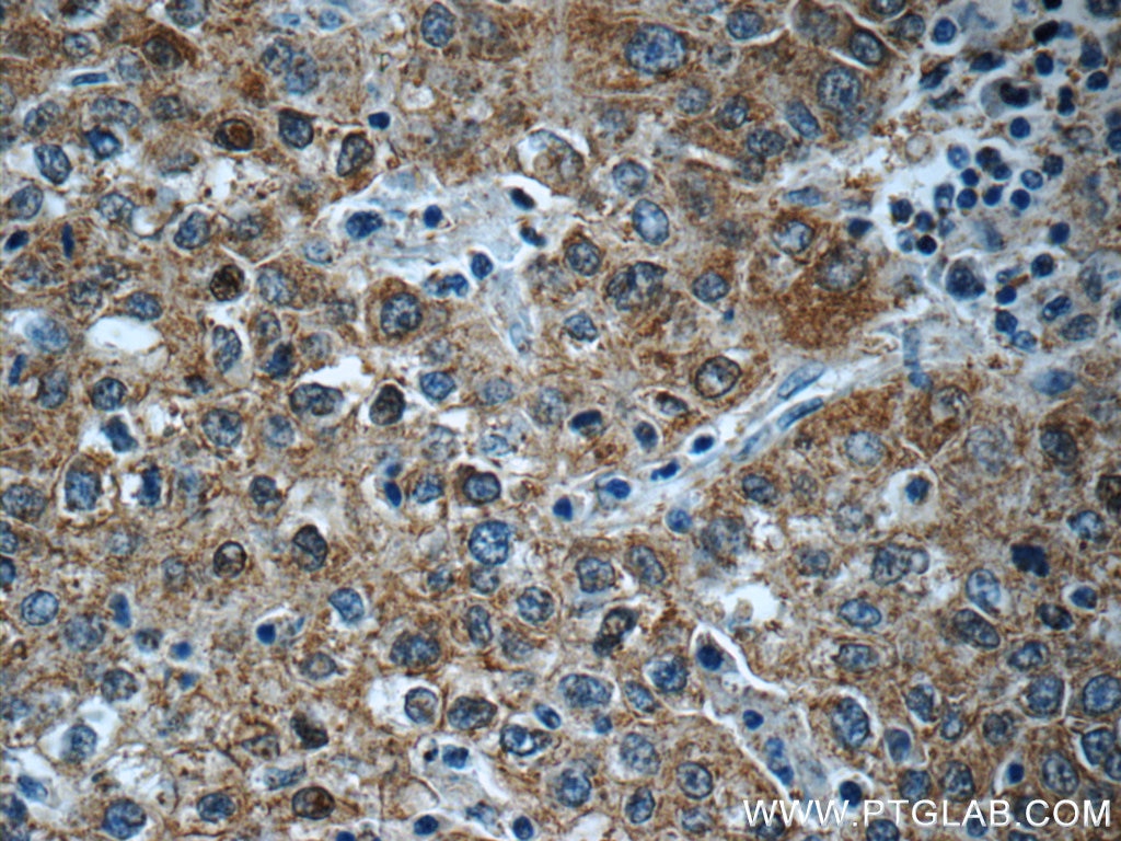 Immunohistochemistry (IHC) staining of human liver cancer tissue using PPP4R2 Polyclonal antibody (22676-1-AP)