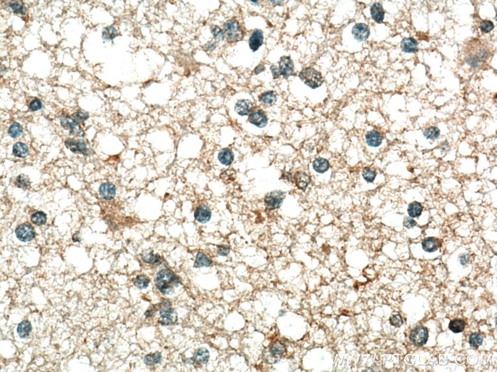 Immunohistochemistry (IHC) staining of human gliomas tissue using PPP5C Polyclonal antibody (11715-1-AP)