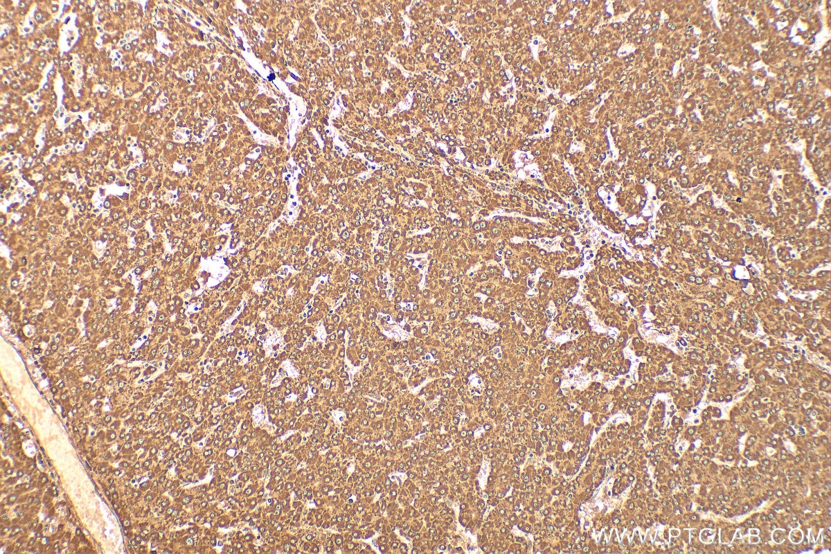 Immunohistochemistry (IHC) staining of human liver cancer tissue using PPPDE1/PNAS4 Polyclonal antibody (20517-1-AP)