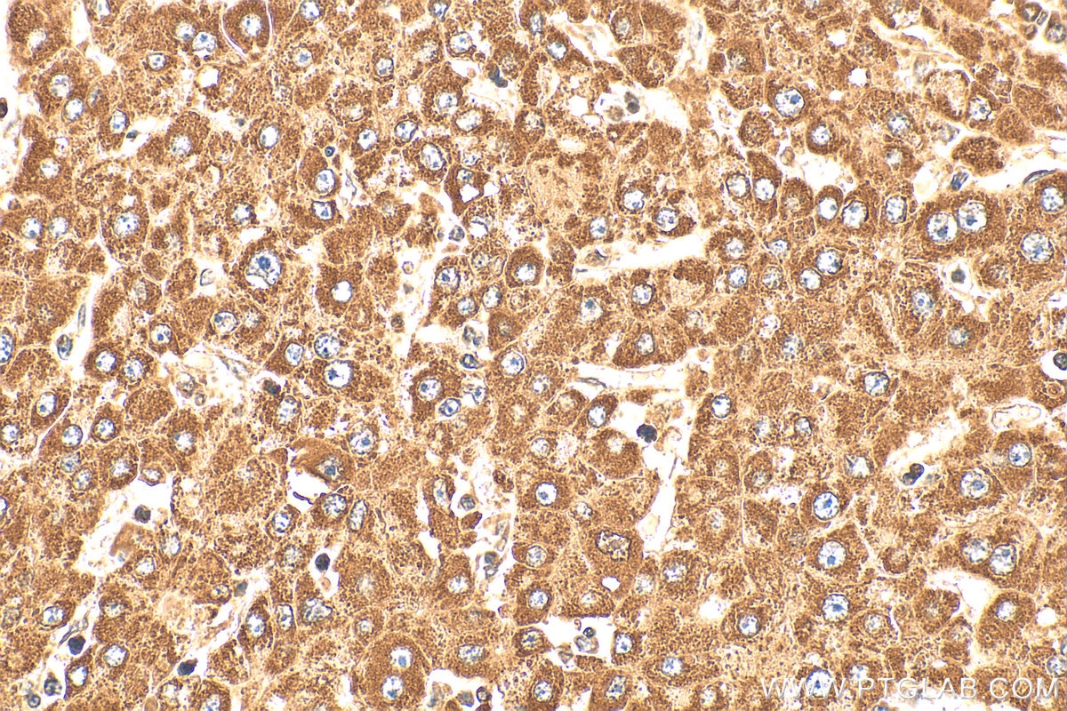 Immunohistochemistry (IHC) staining of human liver cancer tissue using PPPDE1/PNAS4 Polyclonal antibody (20517-1-AP)