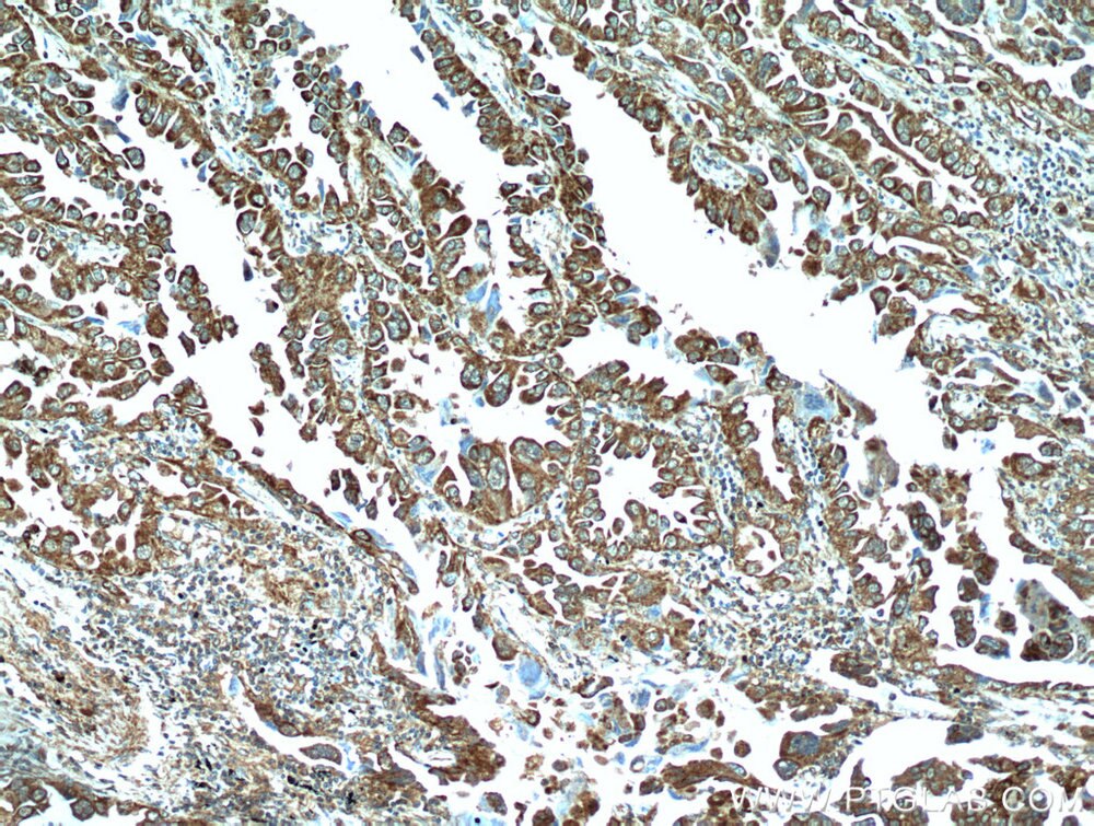 Immunohistochemistry (IHC) staining of human lung cancer tissue using PPPDE1/PNAS4 Polyclonal antibody (20517-1-AP)