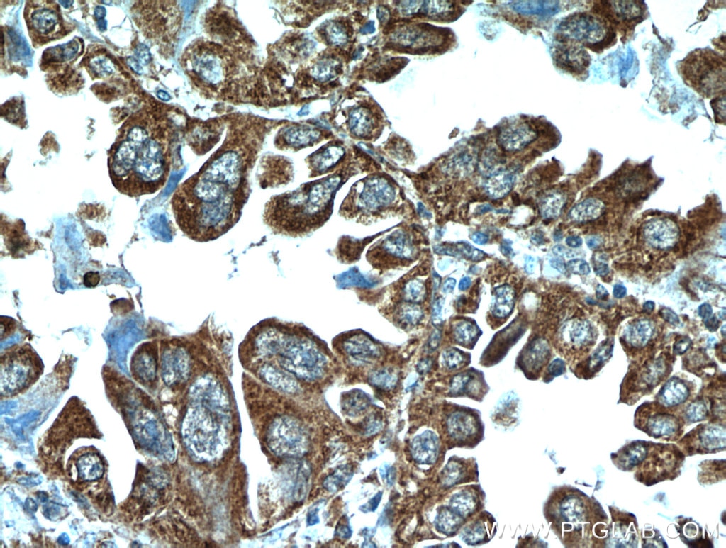 IHC staining of human lung cancer using 20517-1-AP