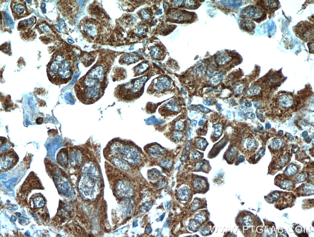 Immunohistochemistry (IHC) staining of human lung cancer tissue using PPPDE1/PNAS4 Polyclonal antibody (20517-1-AP)