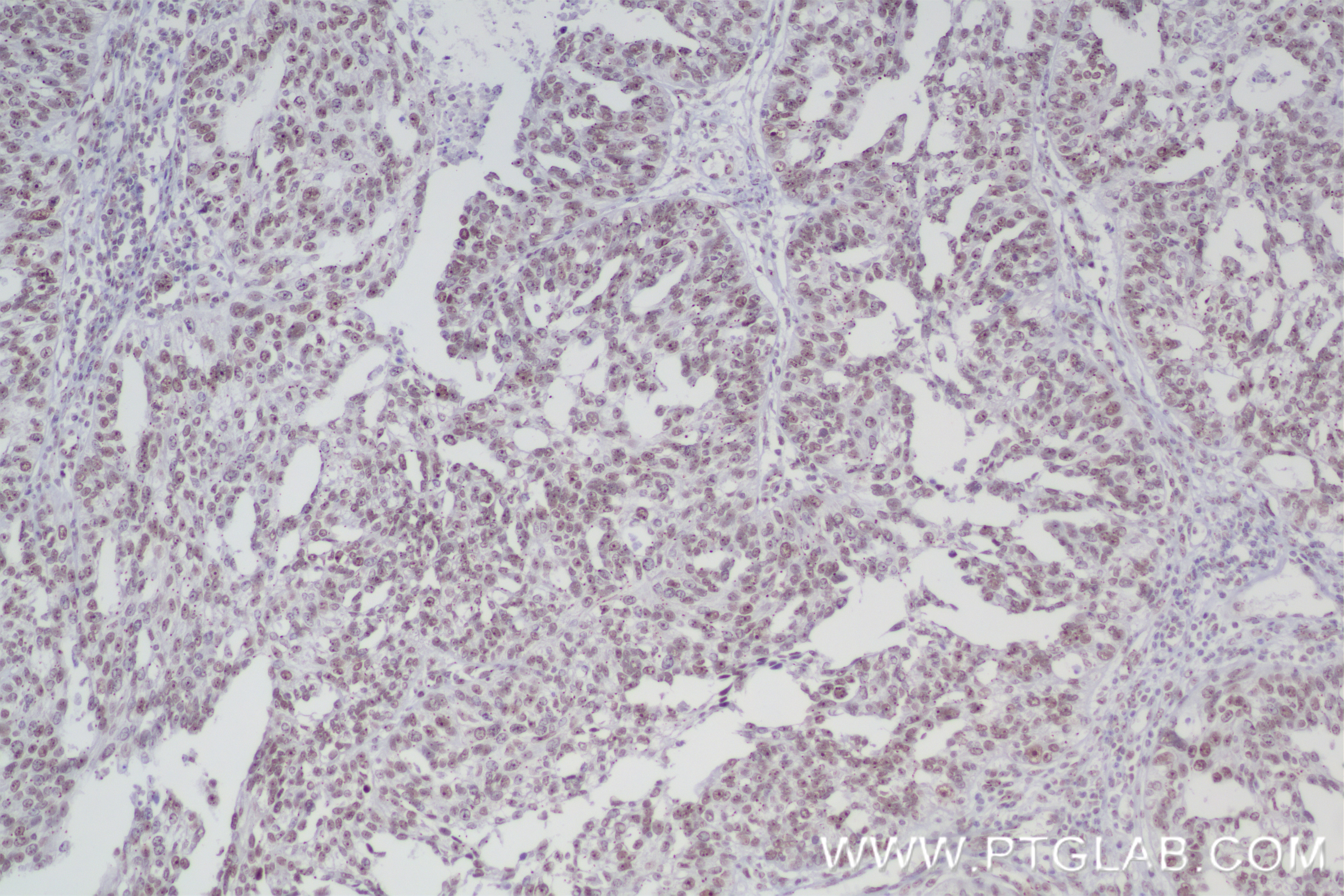 Immunohistochemistry (IHC) staining of human ovary cancer tissue using PQBP1 Recombinant antibody (84491-6-RR)