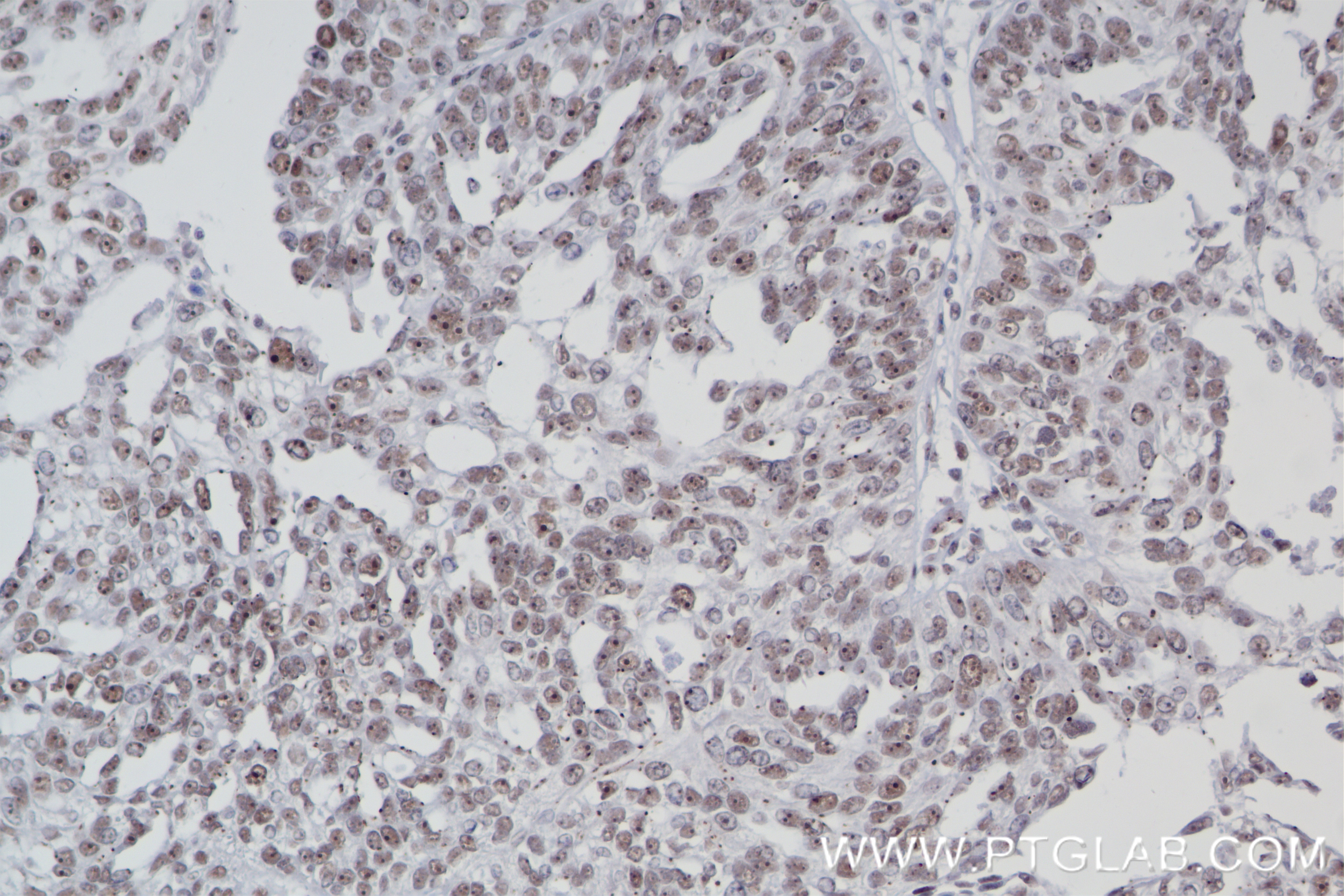 Immunohistochemistry (IHC) staining of human ovary cancer tissue using PQBP1 Recombinant antibody (84491-6-RR)