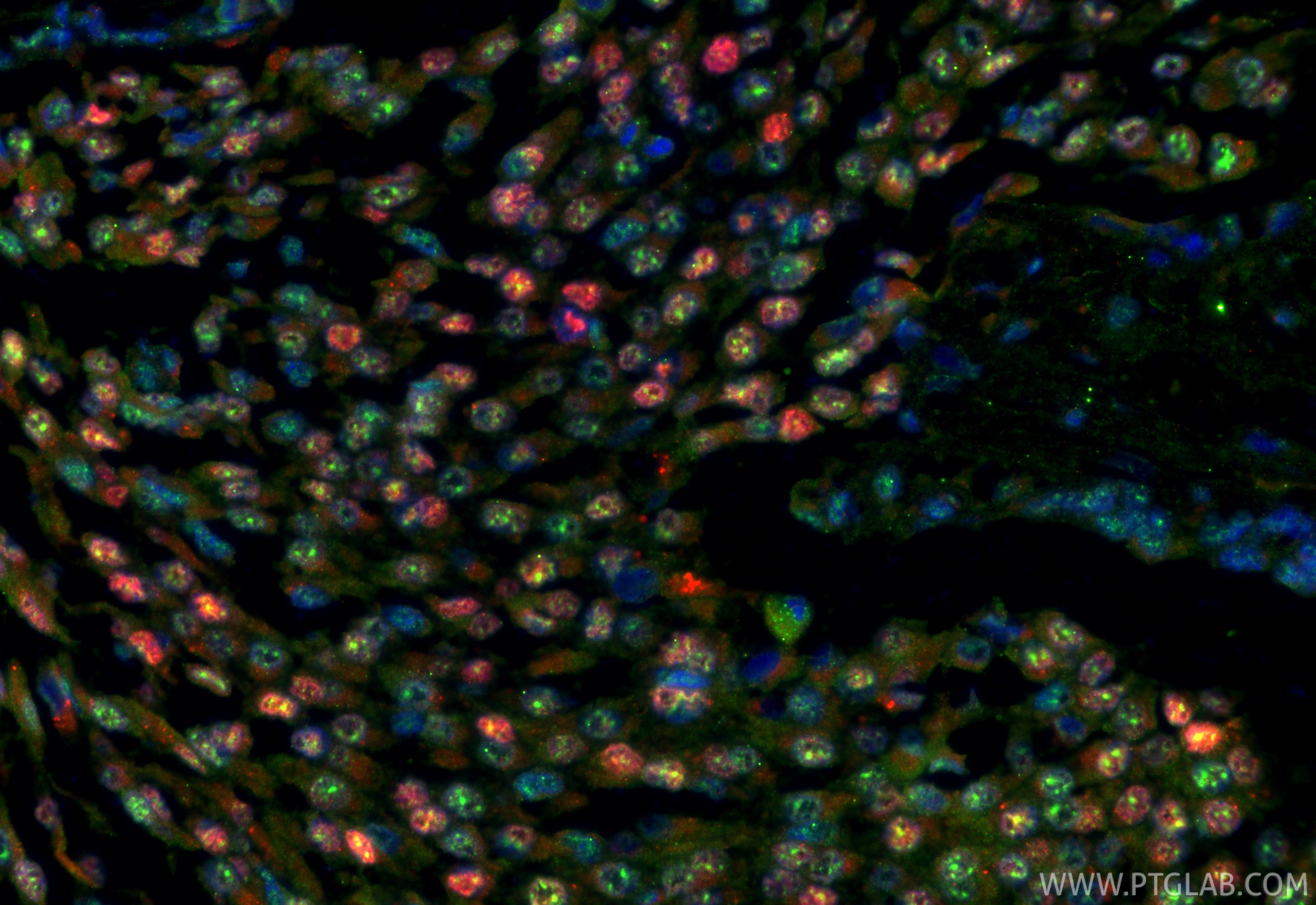 Immunofluorescence (IF) / fluorescent staining of human breast cancer tissue using Progesterone Receptor Polyclonal antibody (25871-1-AP)