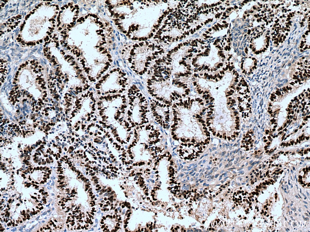 IHC staining of human ovary tumor using 25871-1-AP