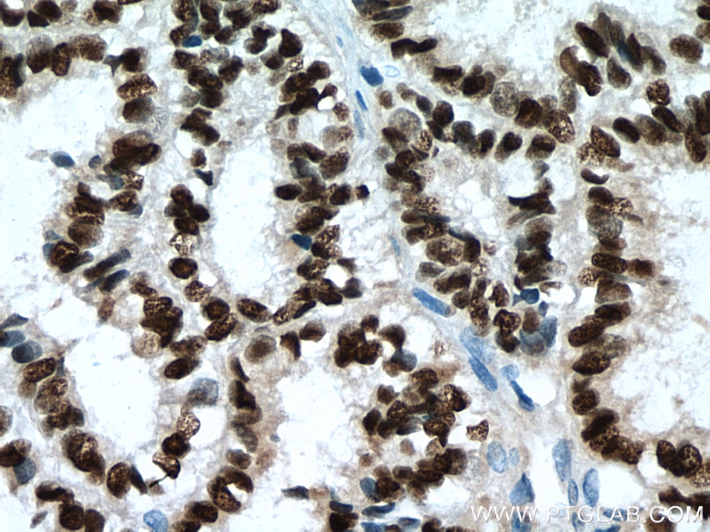 Immunohistochemistry (IHC) staining of human ovary tumor tissue using PR Polyclonal antibody (25871-1-AP)