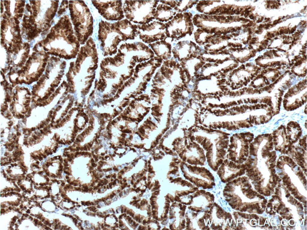 IHC staining of human breast cancer using 25871-1-AP