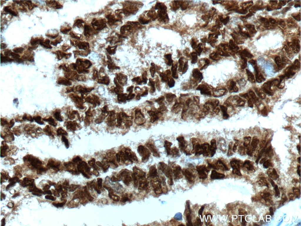 Immunohistochemistry (IHC) staining of human breast cancer tissue using PR Polyclonal antibody (25871-1-AP)
