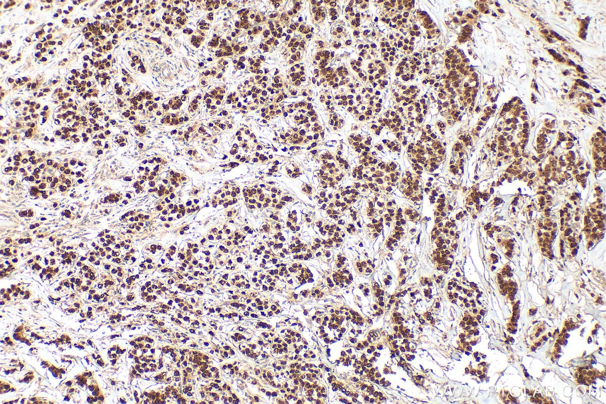 Immunohistochemistry (IHC) staining of human breast cancer tissue using Progesterone Receptor Polyclonal antibody (25871-1-AP)