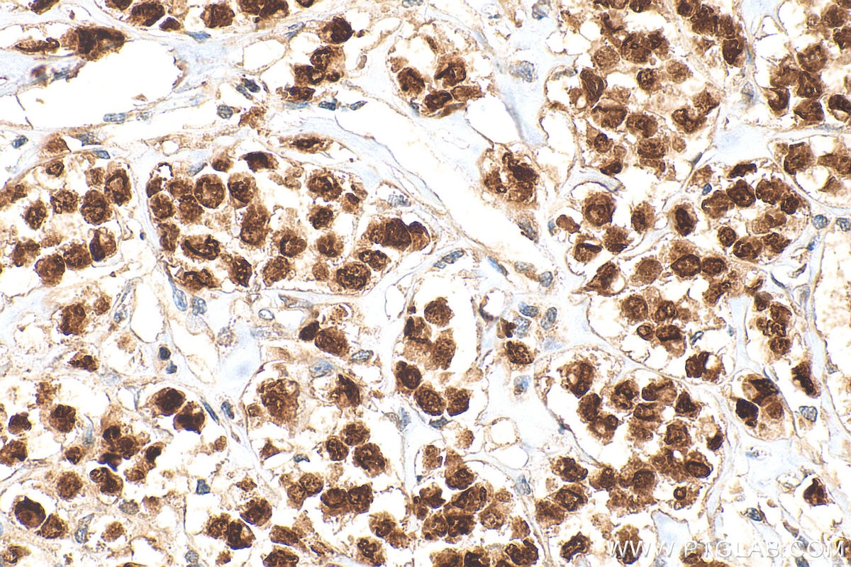 Immunohistochemistry (IHC) staining of human breast cancer tissue using Progesterone Receptor Polyclonal antibody (25871-1-AP)