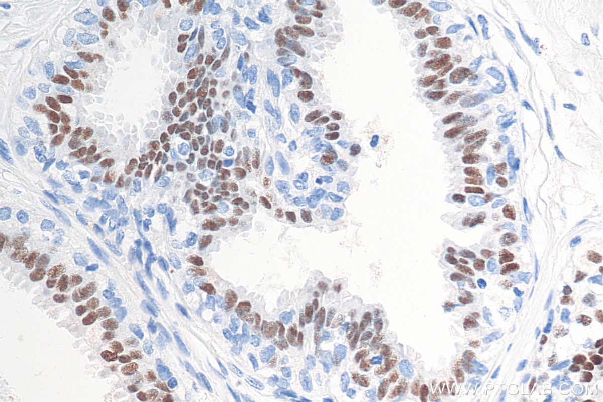Immunohistochemistry (IHC) staining of human breast cancer tissue using PR Monoclonal antibody (66300-1-Ig)