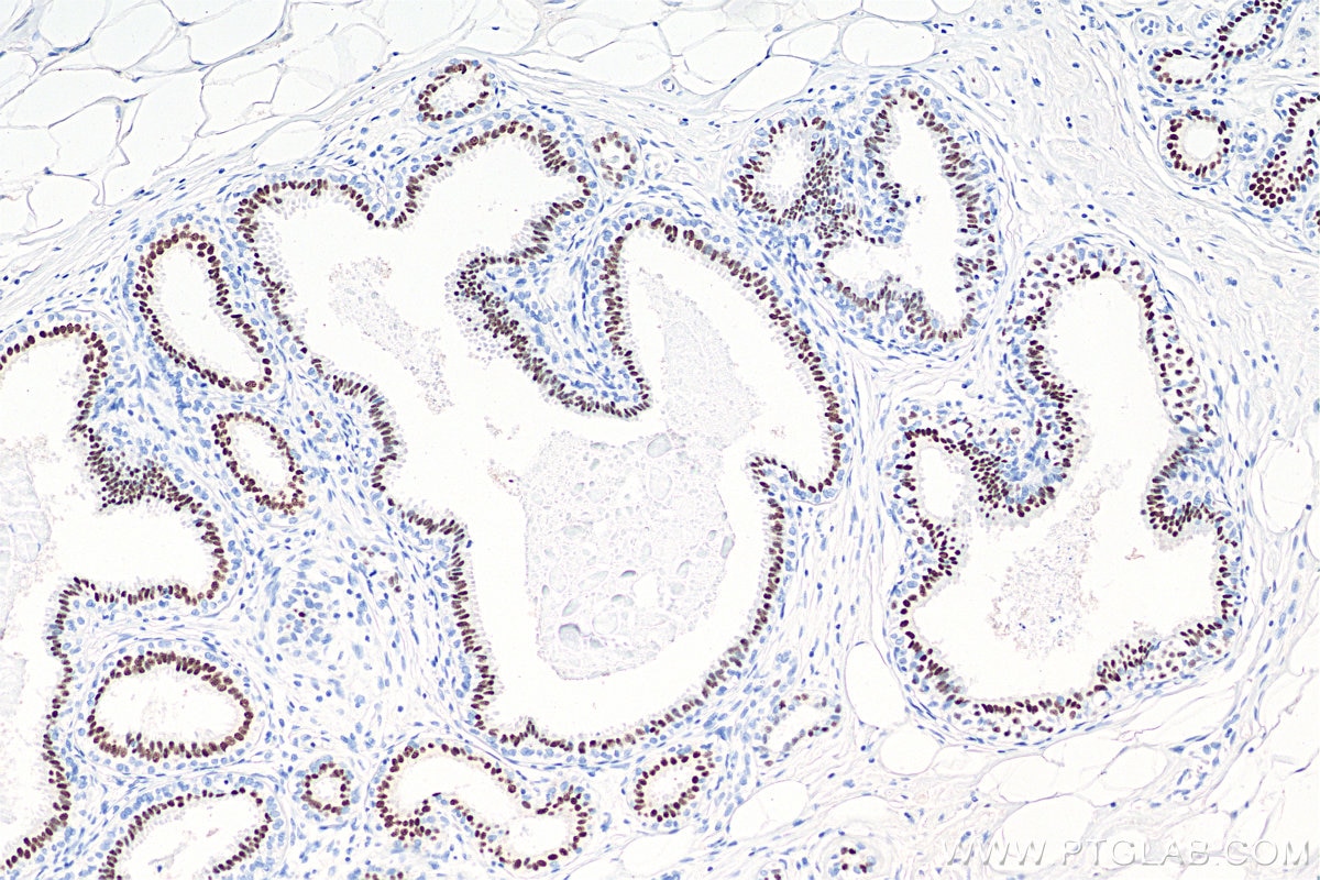 IHC staining of human breast cancer using 66300-1-Ig