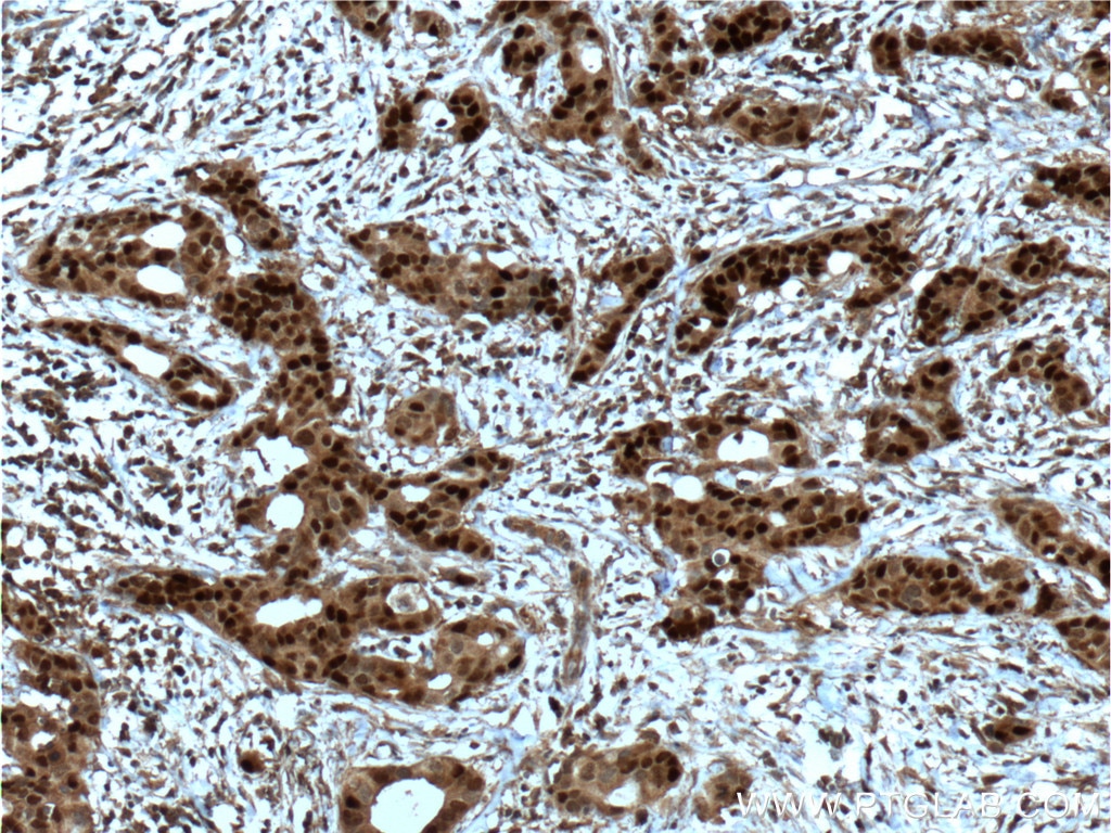 IHC staining of human breast cancer using 66300-1-Ig