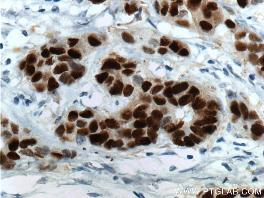 Immunohistochemistry (IHC) staining of human breast cancer tissue using PR Monoclonal antibody (66300-1-Ig)