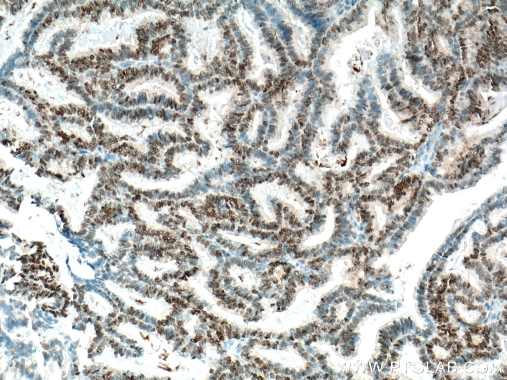 Immunohistochemistry (IHC) staining of human breast cancer tissue using Biotin-conjugated PR Monoclonal antibody (Biotin-66300)