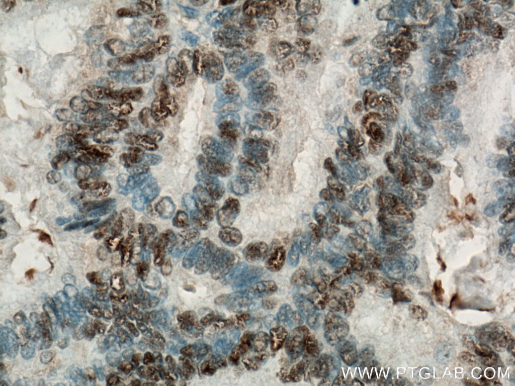 Immunohistochemistry (IHC) staining of human breast cancer tissue using Biotin-conjugated PR Monoclonal antibody (Biotin-66300)