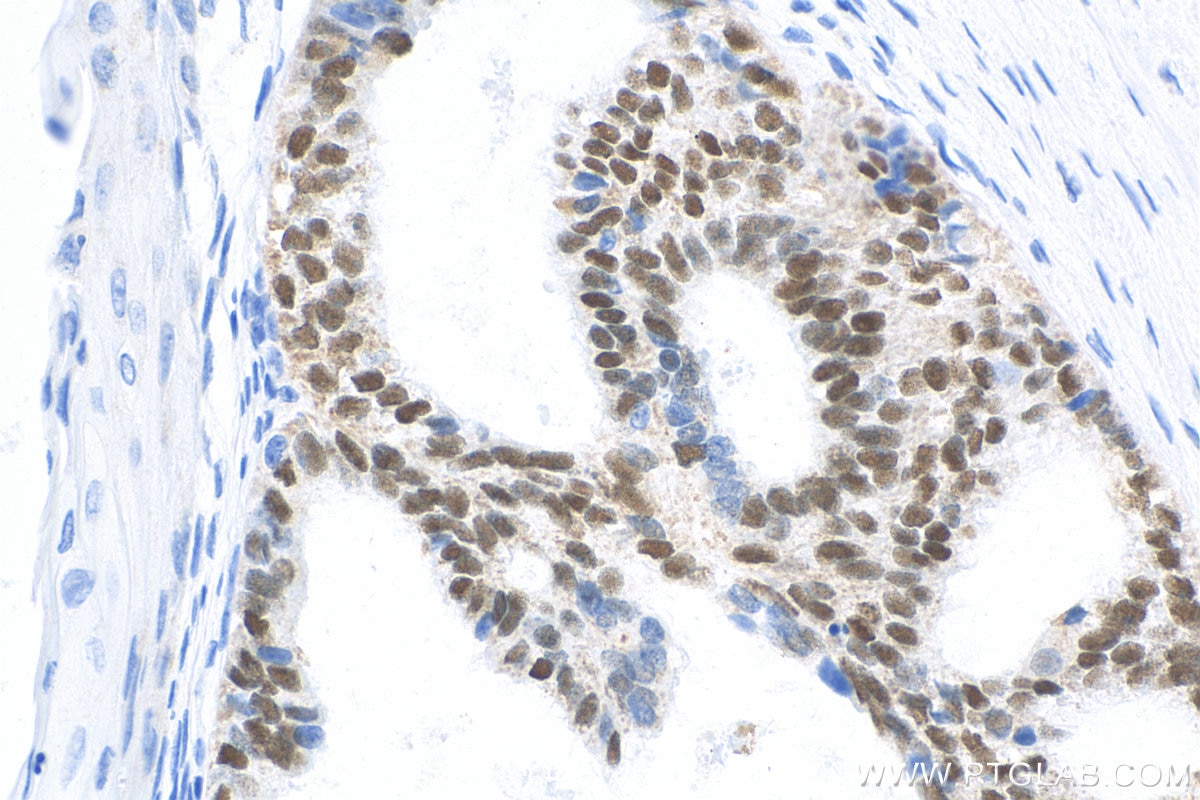Immunohistochemistry (IHC) staining of human ovary tumor tissue using Biotin-conjugated PR Monoclonal antibody (Biotin-66300)