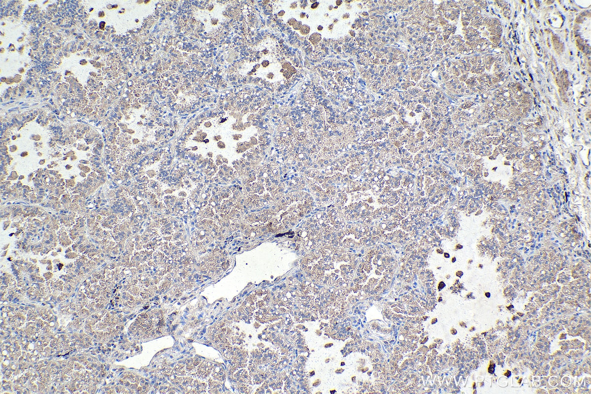 Immunohistochemistry (IHC) staining of human lung cancer tissue using PRAME Polyclonal antibody (11438-1-AP)