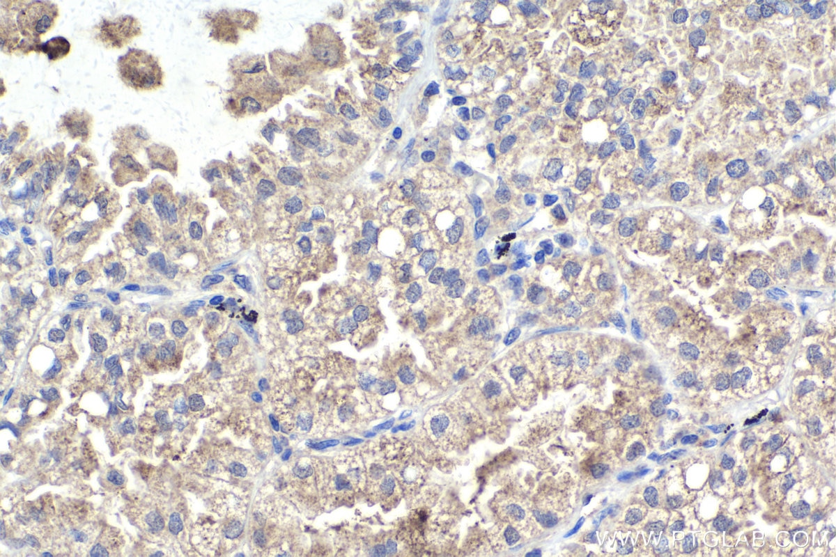Immunohistochemistry (IHC) staining of human lung cancer tissue using PRAME Polyclonal antibody (11438-1-AP)