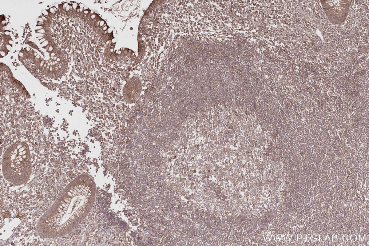 Immunohistochemistry (IHC) staining of human appendicitis tissue using PRAP1 Polyclonal antibody (11932-1-AP)