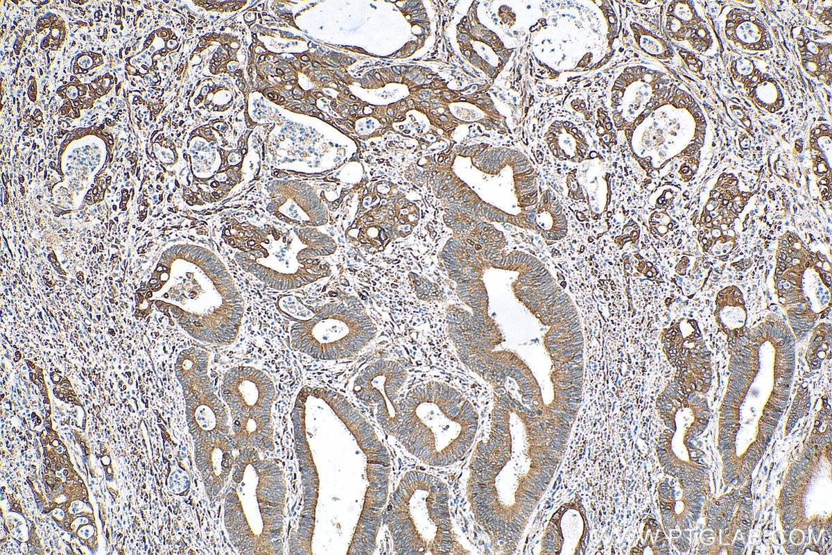 Immunohistochemistry (IHC) staining of human colon cancer tissue using PRC1 Polyclonal antibody (10110-2-AP)