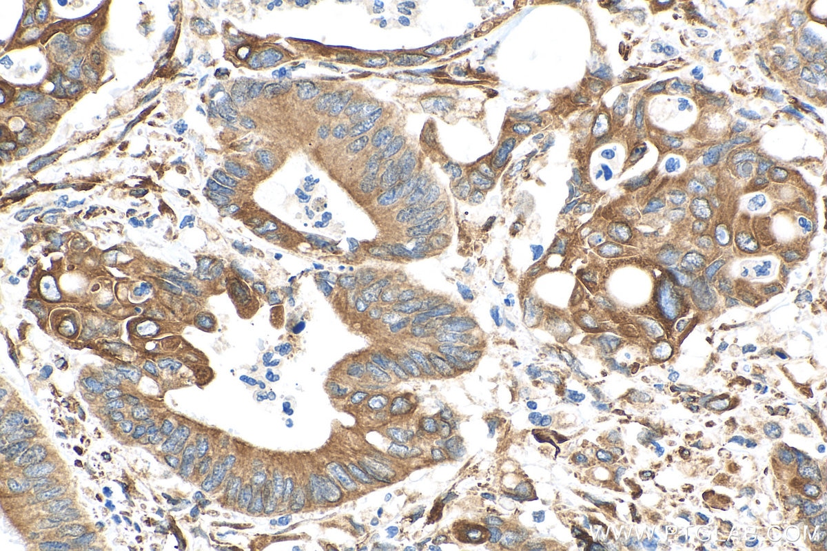 Immunohistochemistry (IHC) staining of human colon cancer tissue using PRC1 Polyclonal antibody (10110-2-AP)