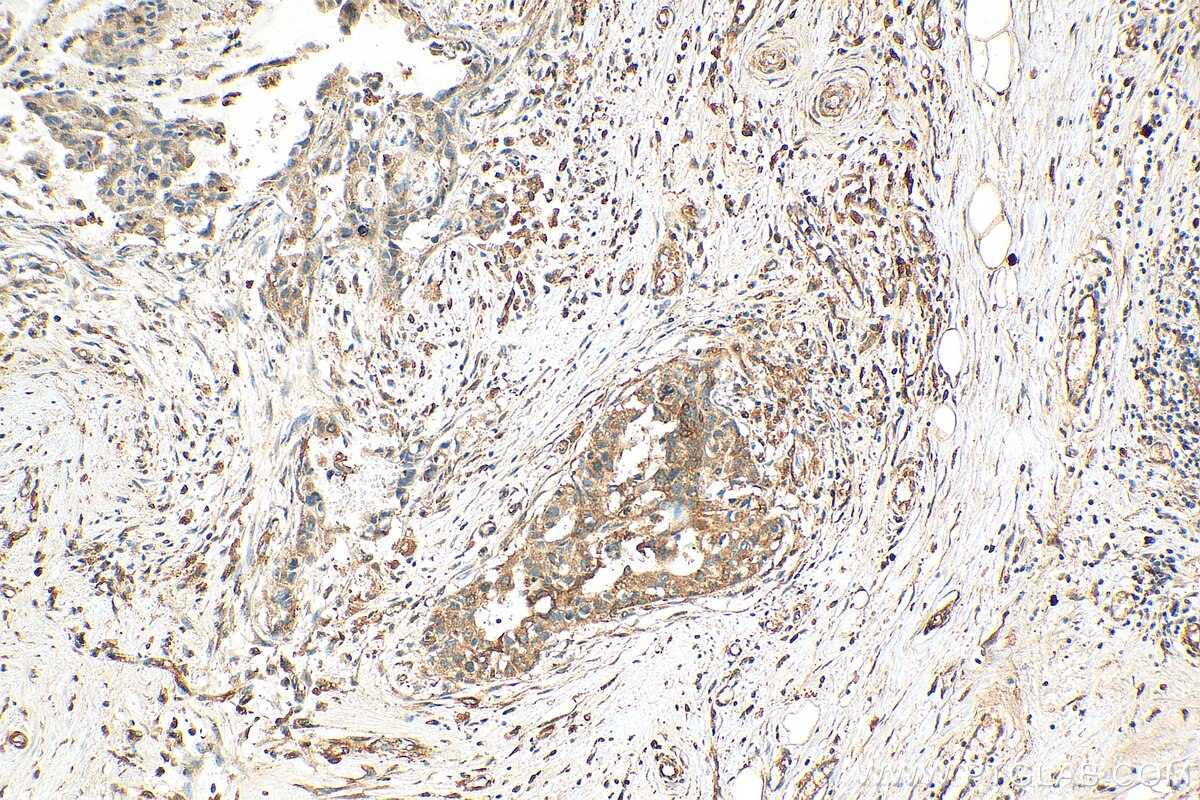 Immunohistochemistry (IHC) staining of human breast cancer tissue using PRC1 Polyclonal antibody (15617-1-AP)