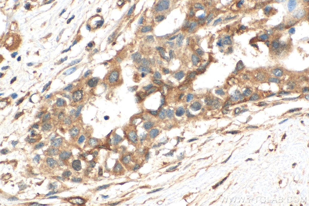Immunohistochemistry (IHC) staining of human breast cancer tissue using PRC1 Polyclonal antibody (15617-1-AP)
