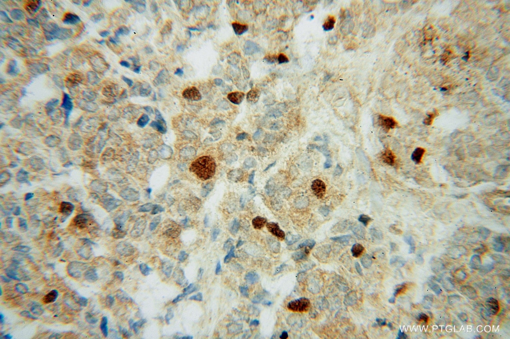 IHC staining of human breast cancer using 15617-1-AP