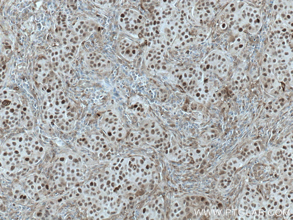 Immunohistochemistry (IHC) staining of human breast cancer tissue using PRC1 Monoclonal antibody (67027-1-Ig)