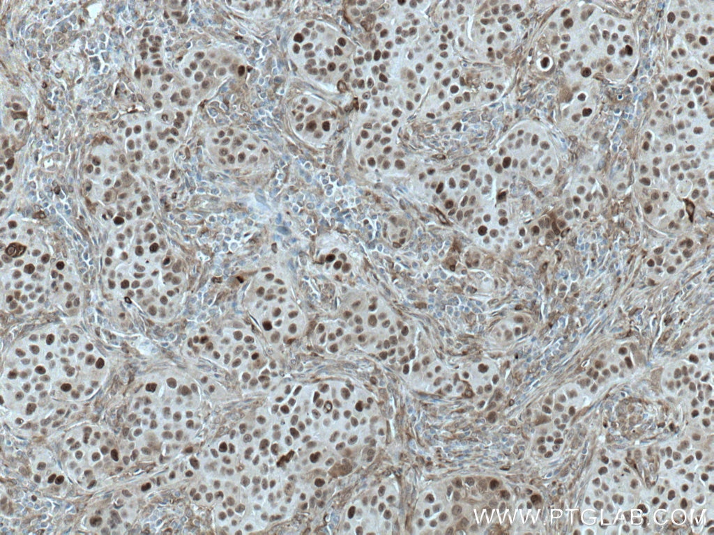 IHC staining of human breast cancer using 67027-1-Ig