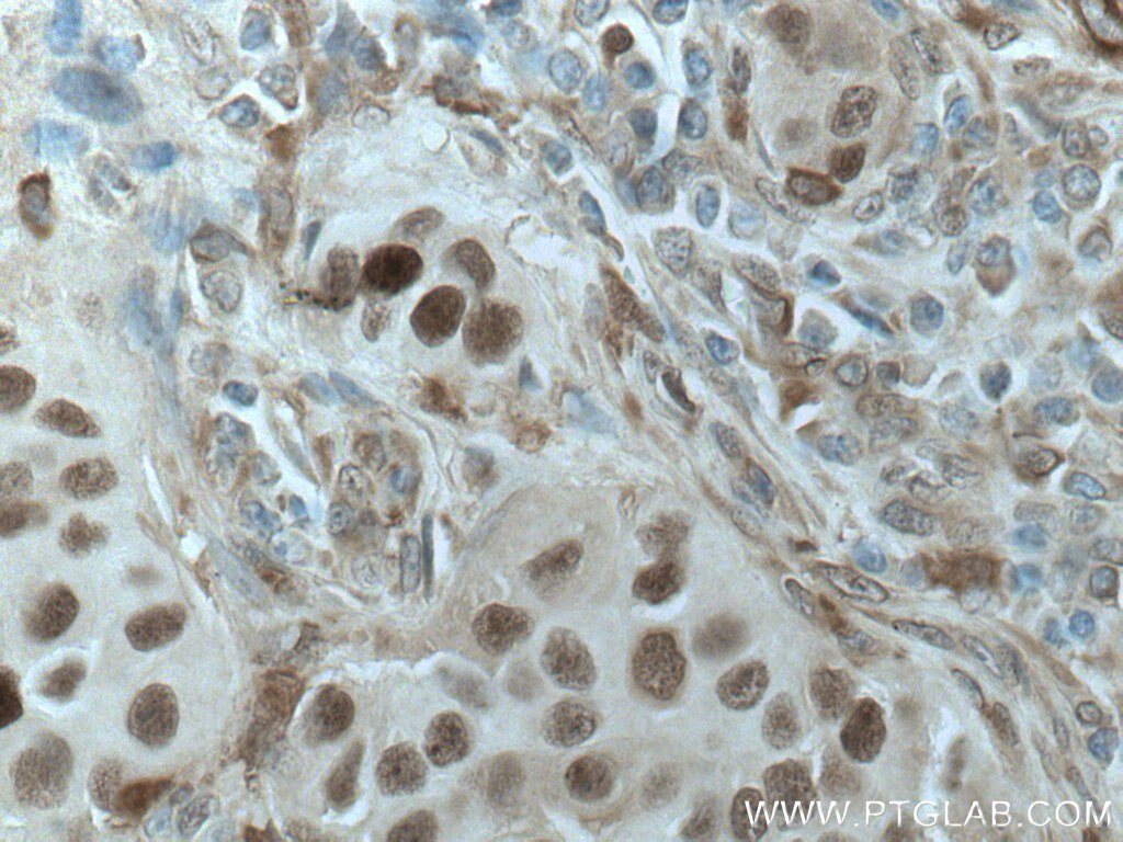 Immunohistochemistry (IHC) staining of human breast cancer tissue using PRC1 Monoclonal antibody (67027-1-Ig)