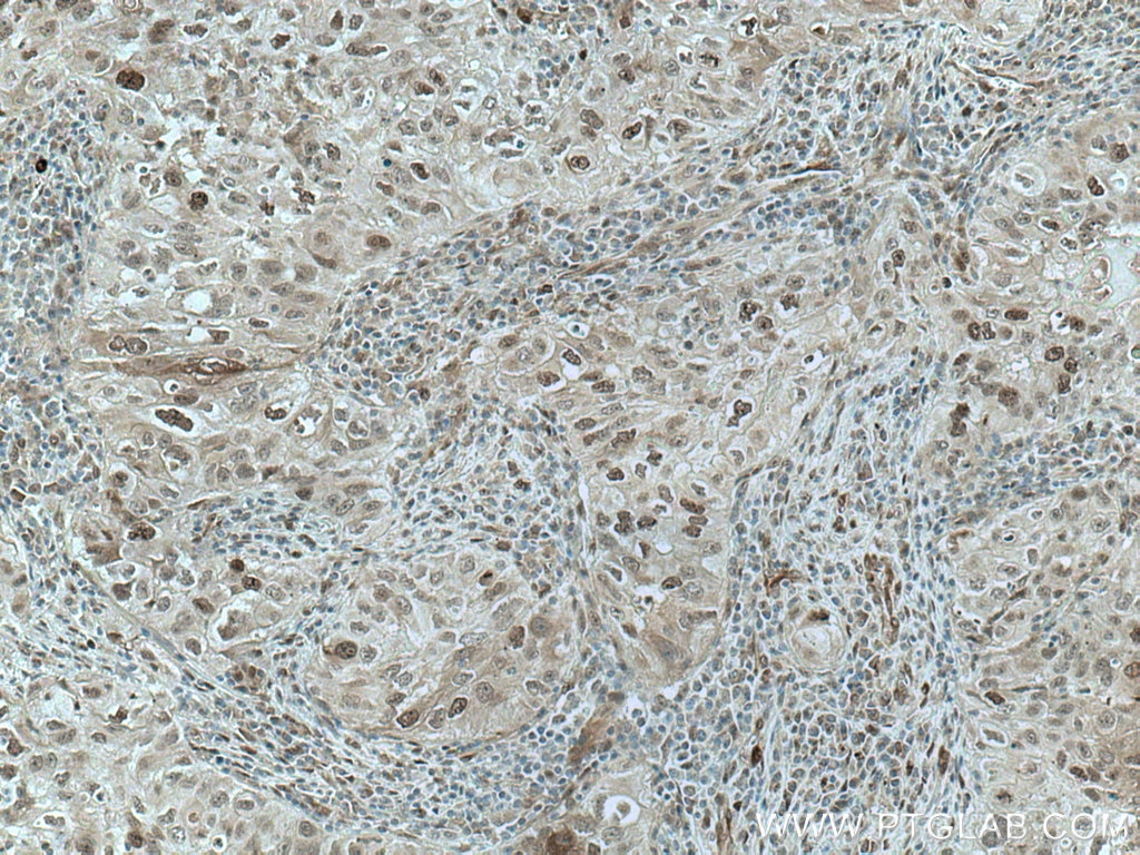 IHC staining of human lung cancer using 67027-1-Ig