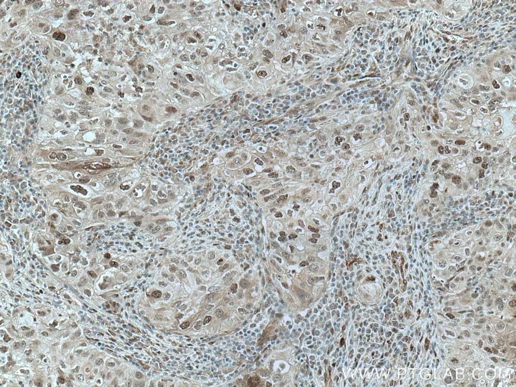 Immunohistochemistry (IHC) staining of human lung cancer tissue using PRC1 Monoclonal antibody (67027-1-Ig)