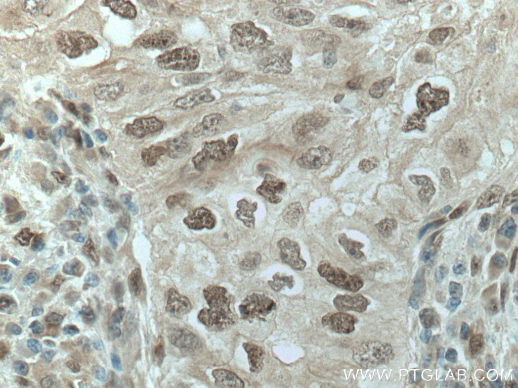 Immunohistochemistry (IHC) staining of human lung cancer tissue using PRC1 Monoclonal antibody (67027-1-Ig)
