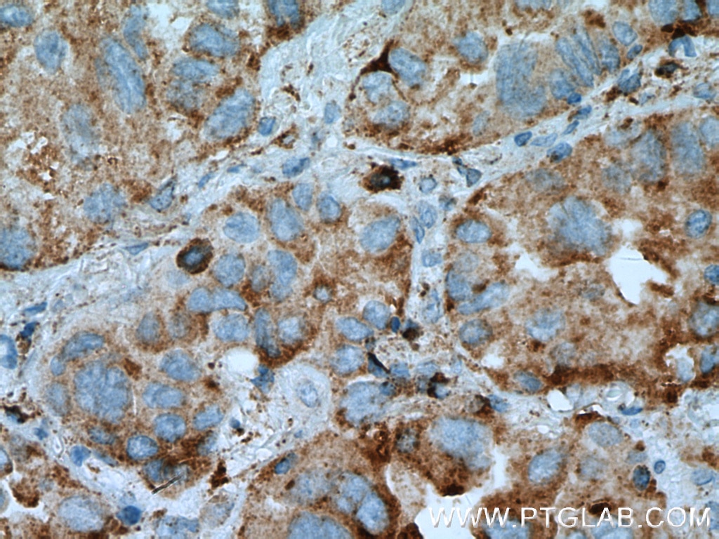 Immunohistochemistry (IHC) staining of human lung cancer tissue using PRCP Polyclonal antibody (15995-1-AP)