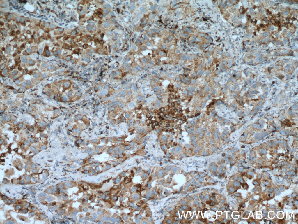 Immunohistochemistry (IHC) staining of human lung cancer tissue using PRCP Polyclonal antibody (15995-1-AP)
