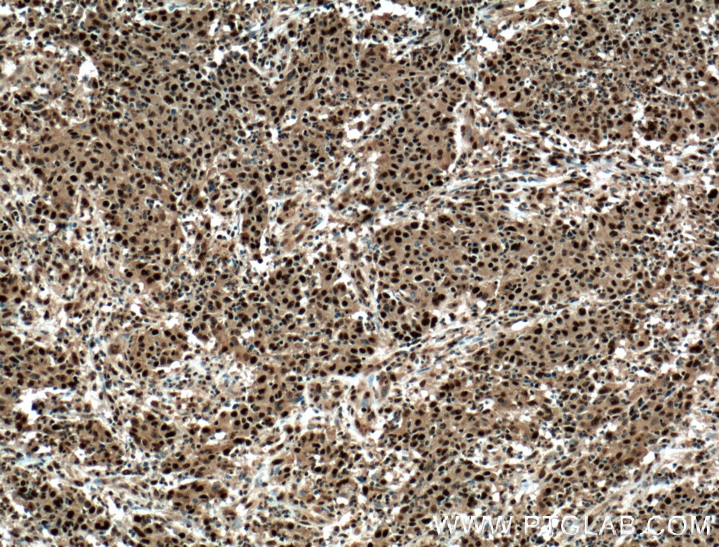 Immunohistochemistry (IHC) staining of human colon cancer tissue using PRDM5 Polyclonal antibody (14126-1-AP)