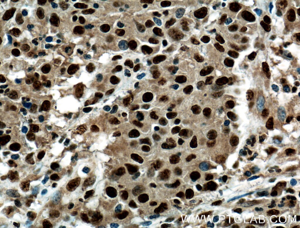 Immunohistochemistry (IHC) staining of human colon cancer tissue using PRDM5 Polyclonal antibody (14126-1-AP)