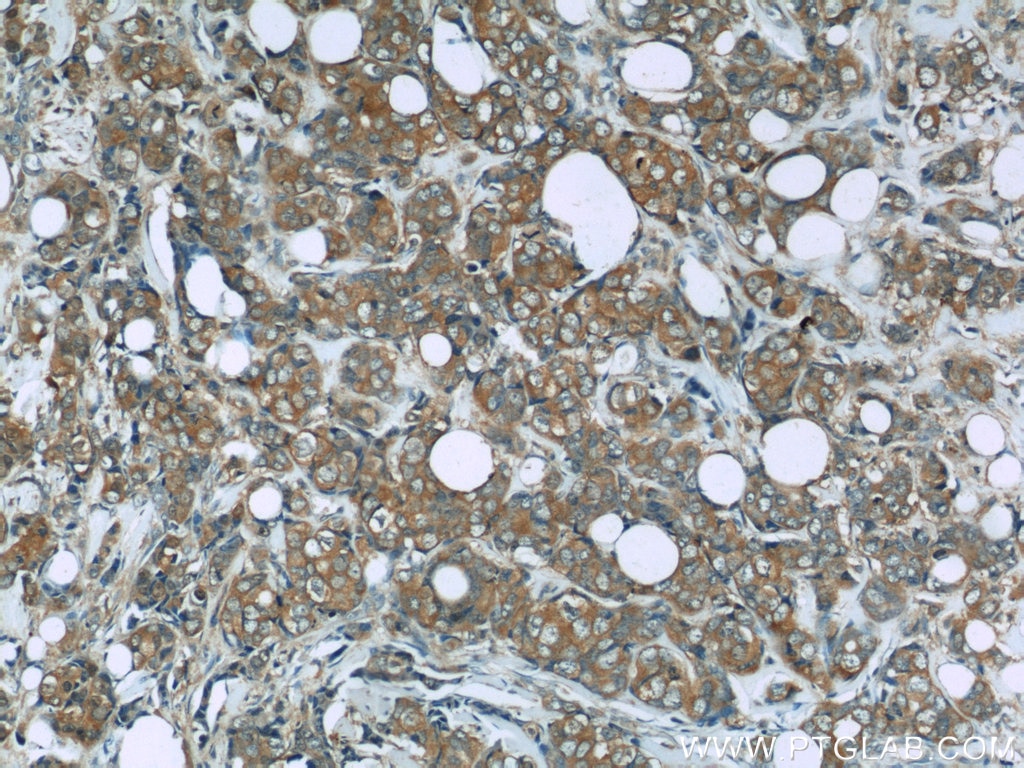 Immunohistochemistry (IHC) staining of human breast cancer tissue using PRDX1 Polyclonal antibody (15816-1-AP)