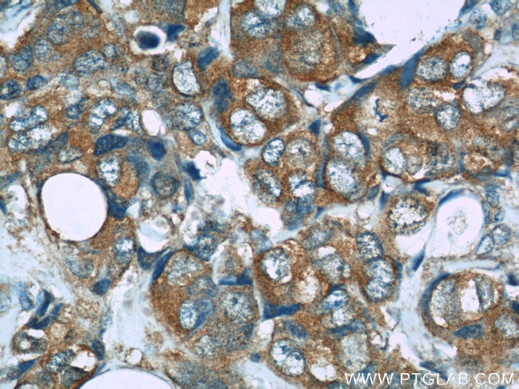 Immunohistochemistry (IHC) staining of human breast cancer tissue using PRDX1 Polyclonal antibody (15816-1-AP)