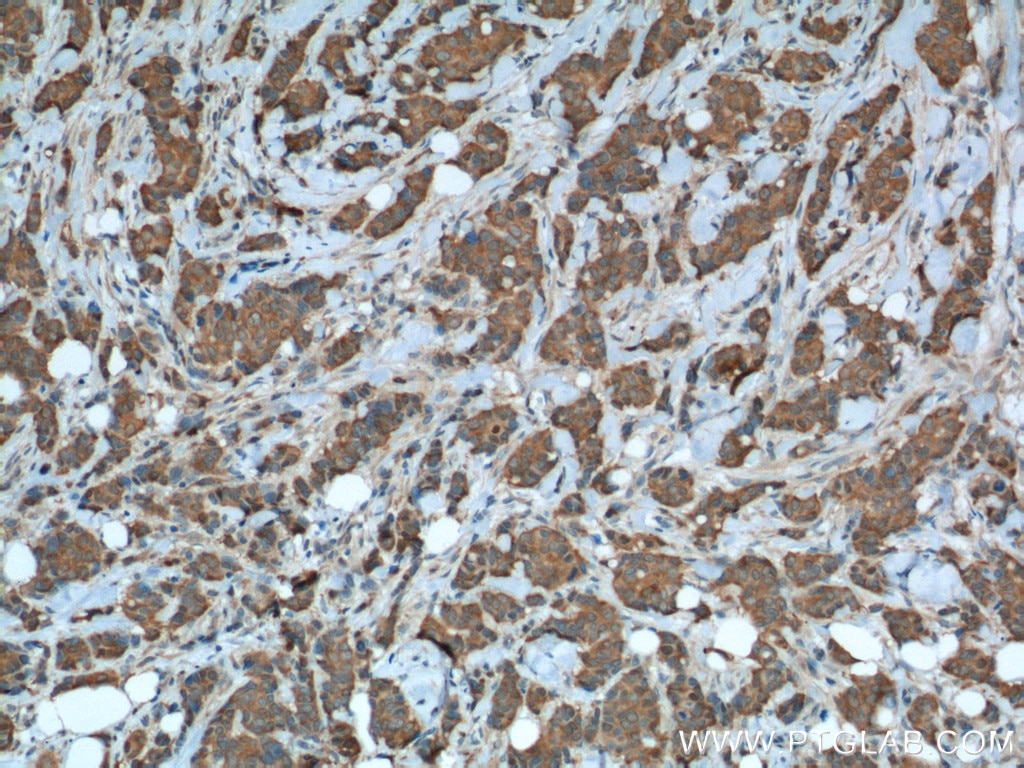 IHC staining of human breast cancer using 15816-1-AP