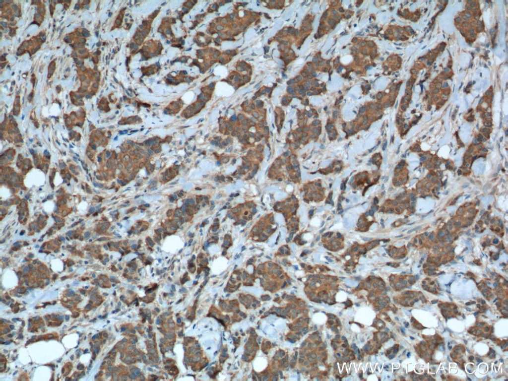 Immunohistochemistry (IHC) staining of human breast cancer tissue using PRDX1 Polyclonal antibody (15816-1-AP)