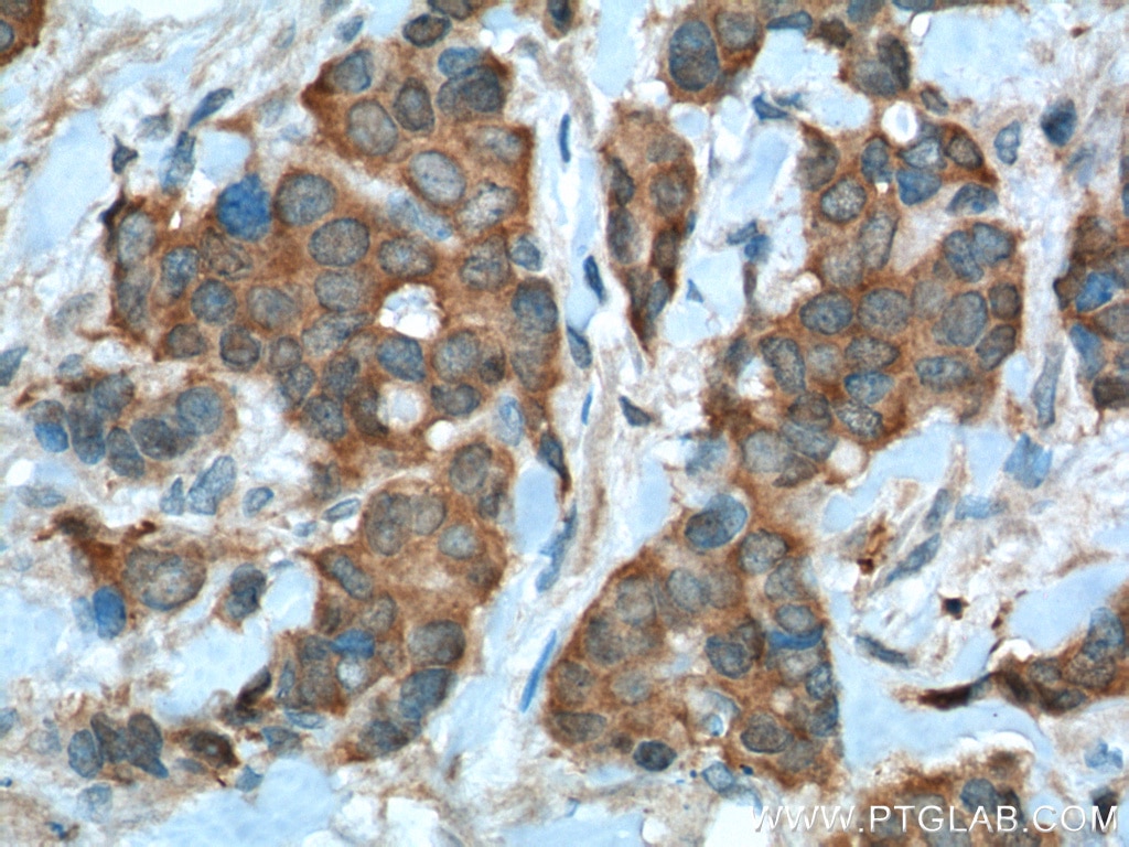 Immunohistochemistry (IHC) staining of human breast cancer tissue using PRDX1 Polyclonal antibody (15816-1-AP)