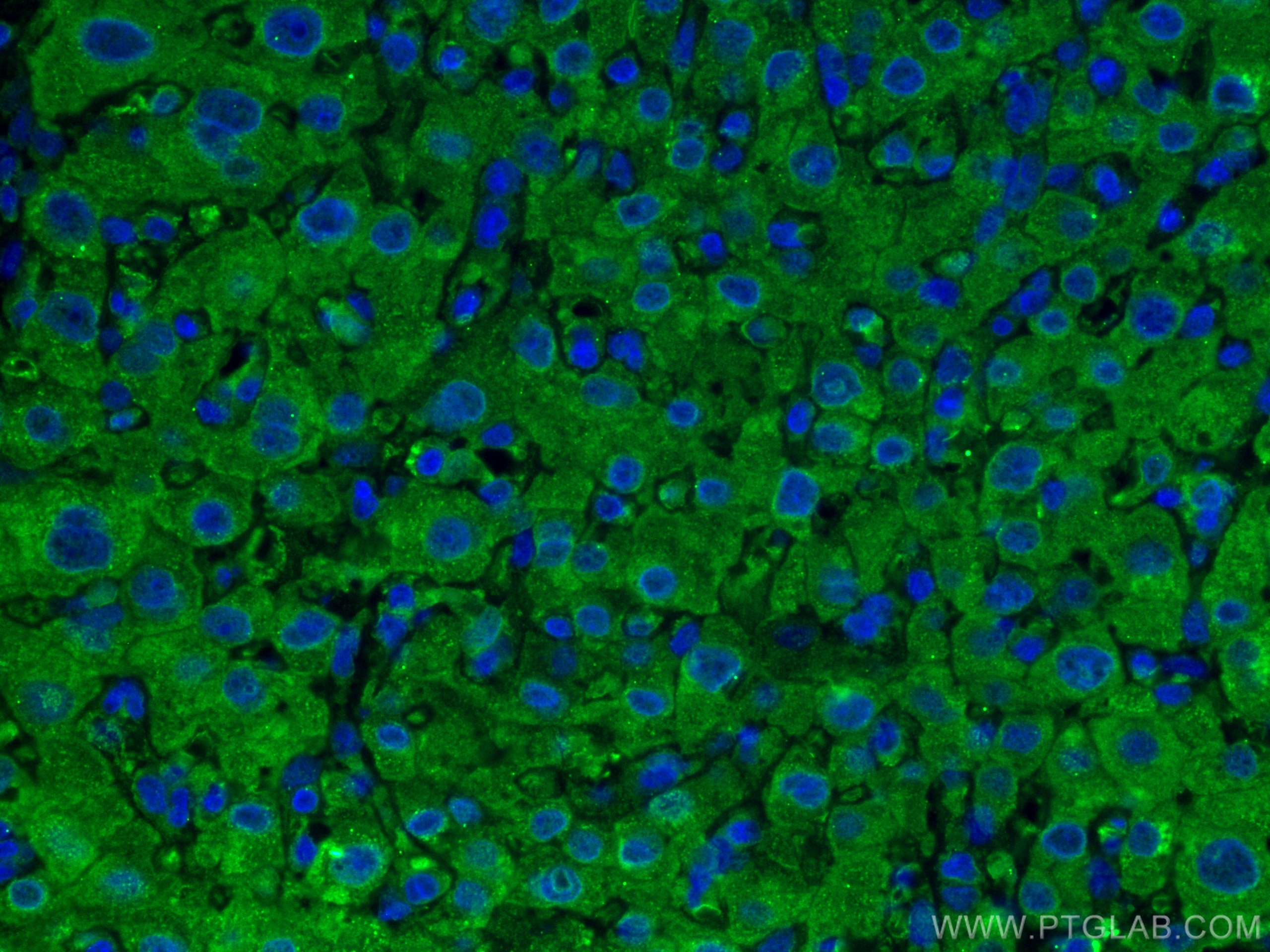 Immunofluorescence (IF) / fluorescent staining of human liver cancer tissue using PRDX1 Monoclonal antibody (66820-1-Ig)